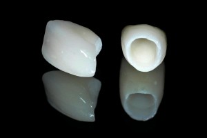 Những lý do để tạo ra răng sứ thẩm mỹ