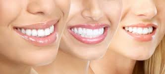 Tẩy trắng răng có hại không? 2