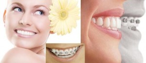 Chỉnh nha với niềng răng một hàm