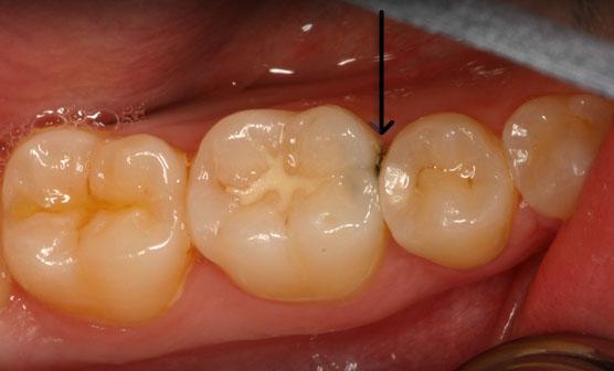 Bọc răng sứ cho răng bị sâu 1