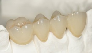 Phục hình cùng răng sứ