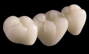 Khác biệt giữa bọc sứ răng và Composite