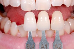 Khác biệt giữa bọc sứ răng và Composite