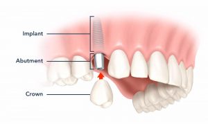Quy trình cấy ghép implant cho răng cửa có nhanh không? 1