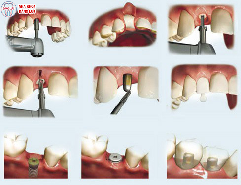 Quy trình cấy ghép implant cho răng cửa có nhanh không? 2