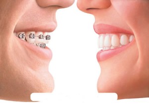 Những điểm cần lưu ý khi điều trị niềng răng