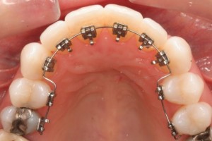 Nhu cầu niềng răng thẩm mỹ
