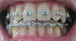 Cách khắc phục hàm răng bị hô nhẹ 