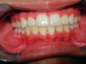 Cách khắc phục hàm răng bị hô nhẹ 
