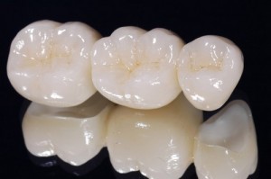 Khung sườn răng sứ titan không gây hại sức khỏe