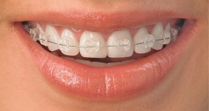 Nên chọn mắc cài sứ hay invisalign để niềng răng? 