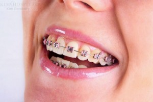 Những vấn đề thường gặp phải khi niềng răng 1