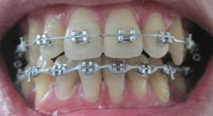 Niềng răng hô có bắt buộc nhổ răng hay không? 