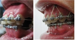 Niềng răng có làm răng yếu đi 1