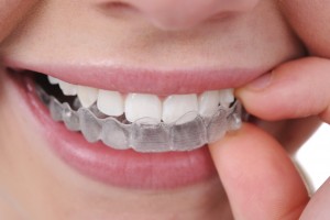 Niềng răng Invisalign mất bao lâu 1