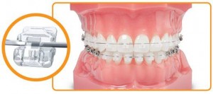 Niềng răng mắc cài sứ trị hô 2 Niềng răng mắc cài sứ trị hô 2