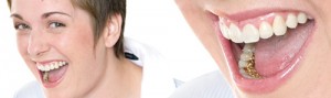 Niềng răng mặt trong có ưu điểm gì 3