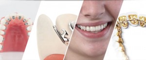 Niềng răng mặt trong có ưu điểm gì 4