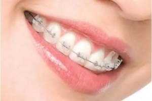 Chi phí niềng răng một hàm có cao không? 