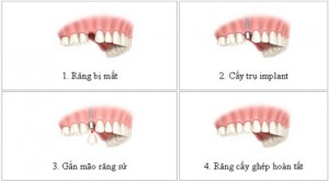 Điểm khác biệt trong giải pháp trồng răng implant