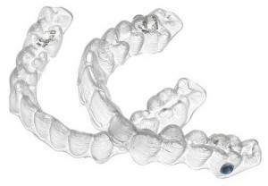 Giải pháp niềng răng invisalign có nhanh và hiệu quả không