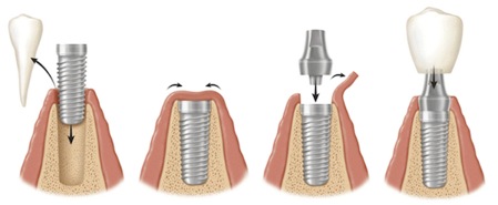 Cấu tạo của răng implant là gì?