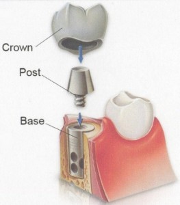 Cấu tạo của răng implant là gì?
