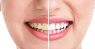 Những phương pháp tẩy trắng răng an toàn 2