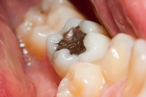 Nên điều trị răng sâu trước khi niềng răng 