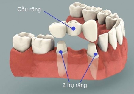 Bạn cần biết về những phương pháp trồng răng