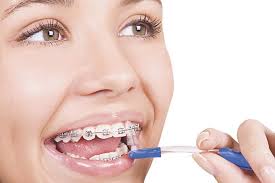 Điều trị niềng răng tại nha khoa hiện nay