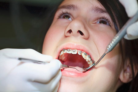 Phương pháp thẩm mỹ hàm răng với niềng răng