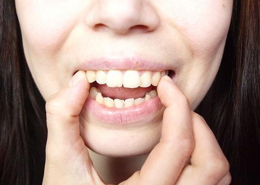 Răng hô và cách điều trị