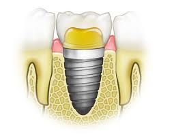 Tại sao trồng răng implant là phương pháp tốt nhất