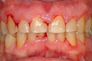 Bệnh viêm nướu có thể làm mất răng hay không? 