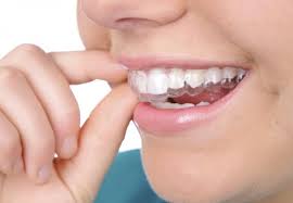 Thực hiện niềng răng bằng phương pháp invisalign