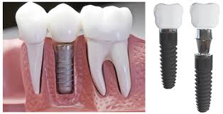 Có nên trồng răng implant thay thế răng bị mất