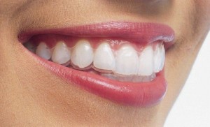 Giải pháp niềng răng thẩm mỹ thích hợp cho người lớn