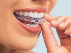 Sở hữu hàm răng thẳng đều bằng biện pháp niềng răng