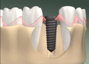 Bảo vệ xương hàm khi mất răng bằng giải pháp implant