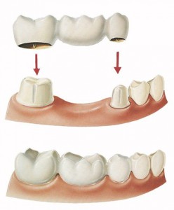 Làm răng giả vĩnh viễn có chất liệu bằng sứ
