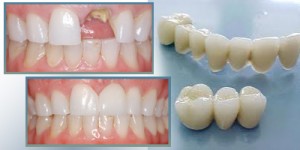 Những giải pháp phục hình khi mất một răng cửa