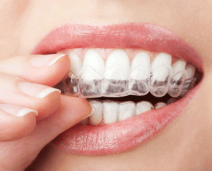 Niềng răng invisalign có nhổ răng được không?