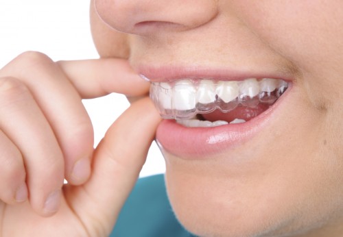 Niềng răng invisalign có nhổ răng được không?