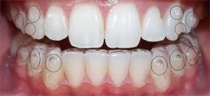 Tìm hiểu về các loại niềng răng thẩm mỹ