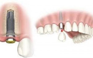 Giải pháp làm răng giả thích hợp khi mất một răng