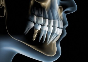Giải pháp trồng răng giả cố định nào tốt nhất?