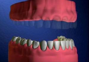 Giải pháp trồng răng hiện đại khi người cao tuổi mất răng
