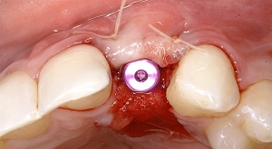 Implant nha khoa phục hình răng đã mất