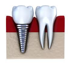 Implant và chi phí trồng răng